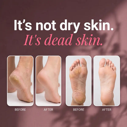 Nue Electric Callus Remover